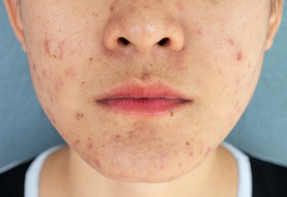 Vitamin E for Acne Scarring: Does it Work?