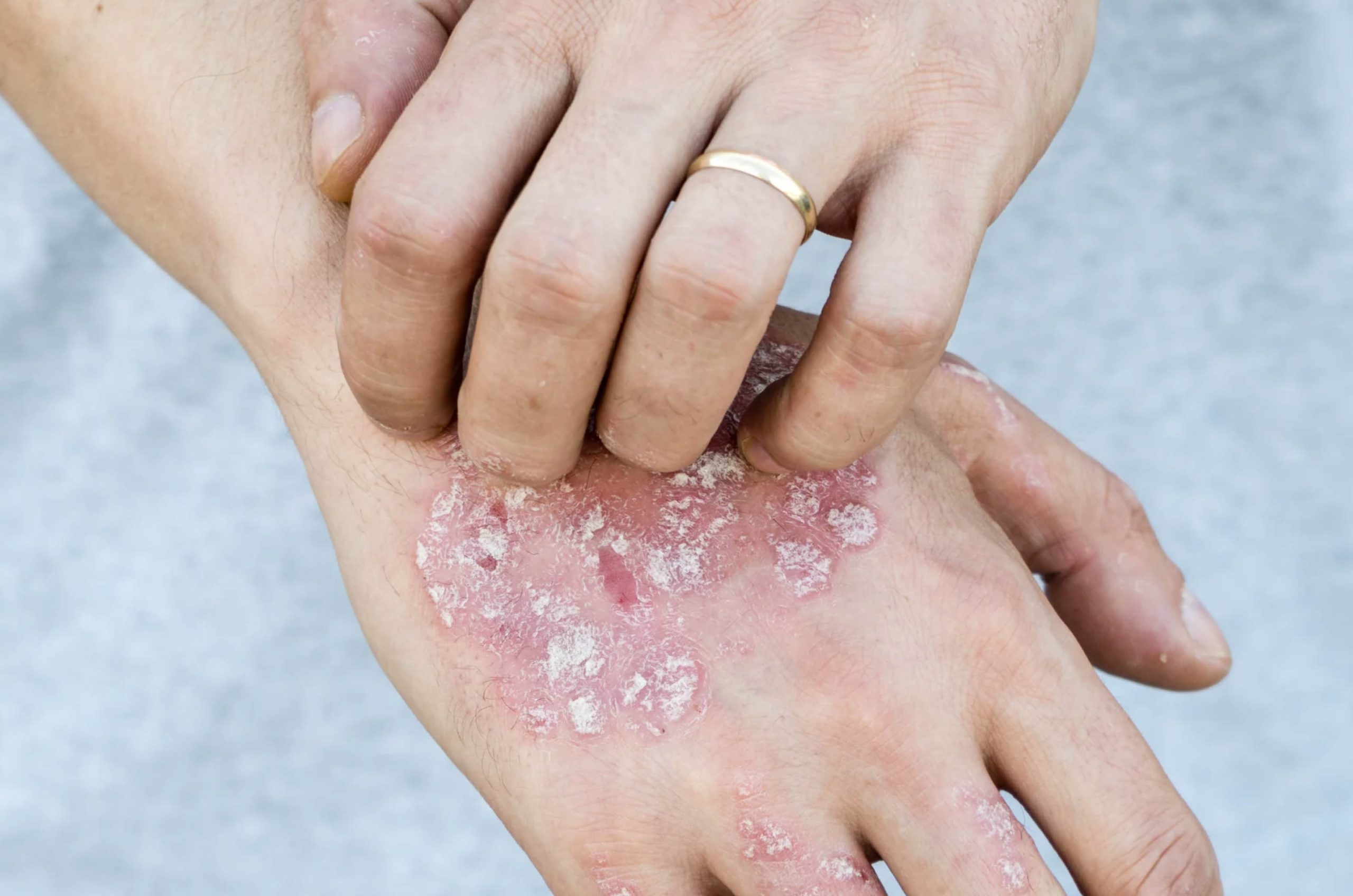 ACGrace - A person's hand with psoriasis on it.