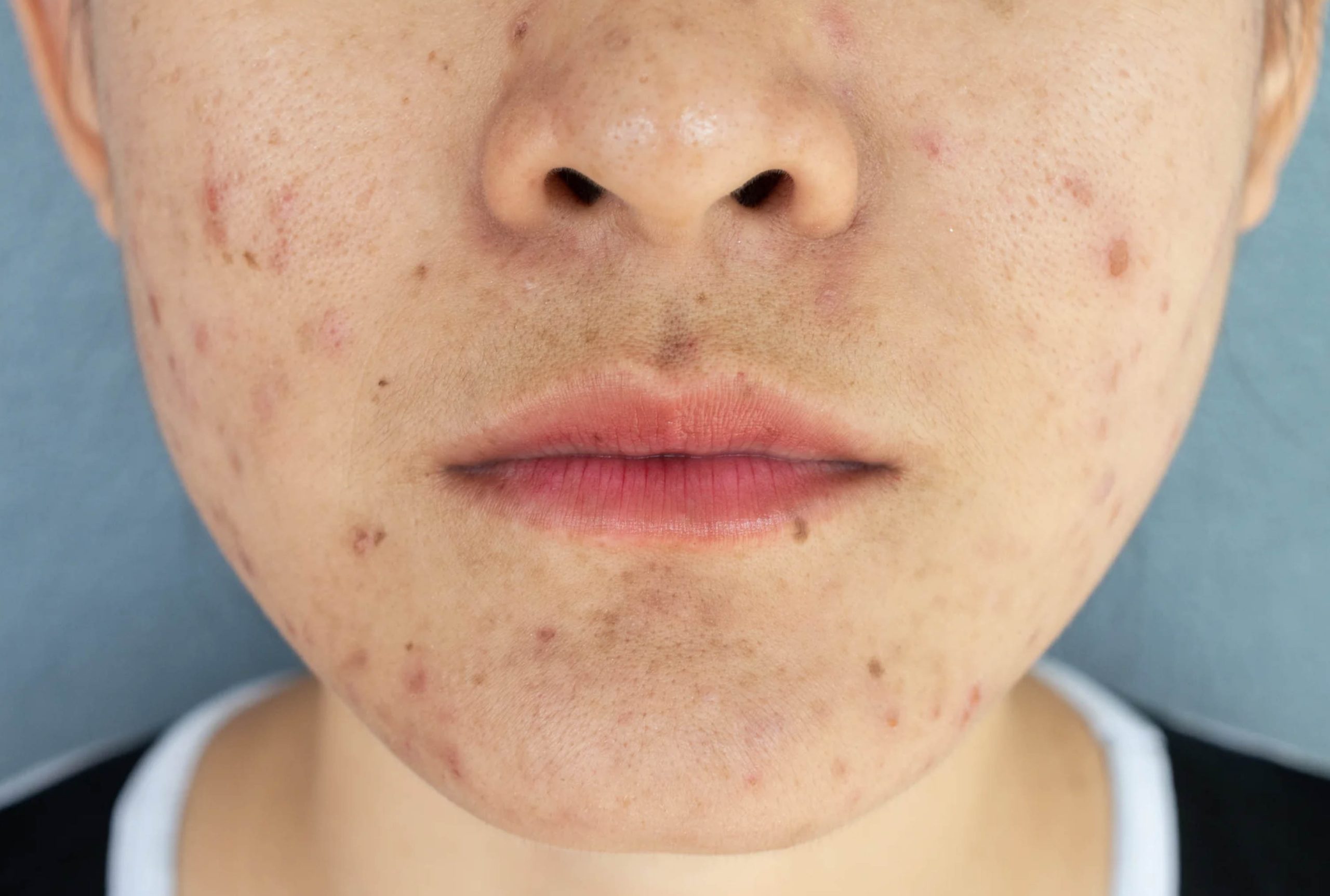 ACGrace - A close up of a woman's face with acne.