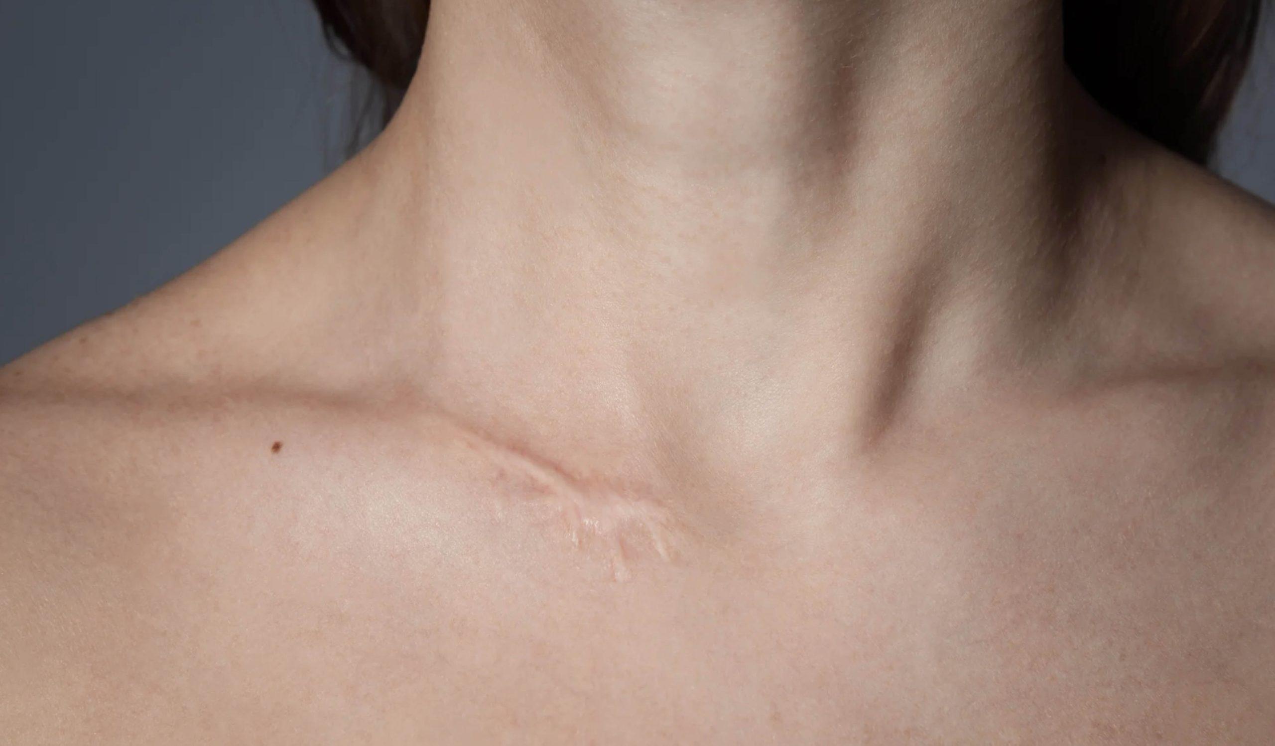 ACGrace - A woman with a scar on her neck.